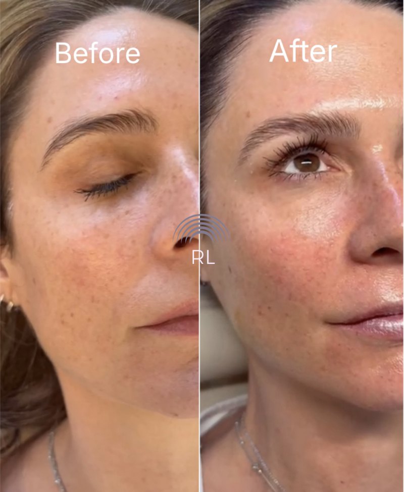 Icon Platinum Touch: Starter Lift x 3 Treatments