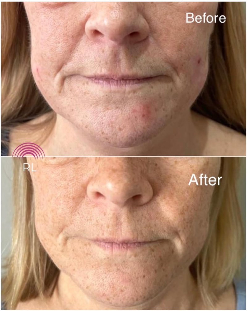 HIFU Lower Face – Summer Sale